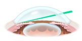 laser_trabeculoplasty laser_trabeculoplasty